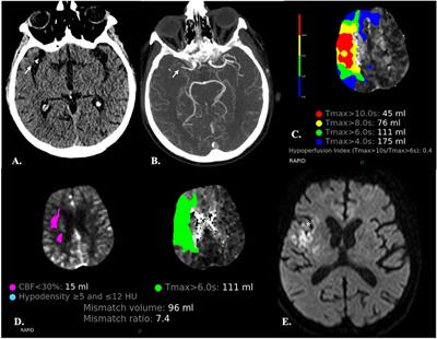 CT perfusion imaging in aneurysmal subarachnoid hemorrhage. State of the art